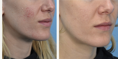 25-34 year old woman treated with Microneedling - Microneedling w/ PRP after two treatments.