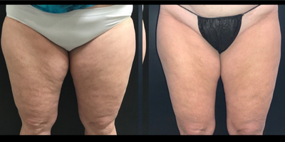 45-54 year old woman treated with truSculpt - One session of TruSculpt ID. 12 weeks apart. Patient could use another 1-2 sessions.