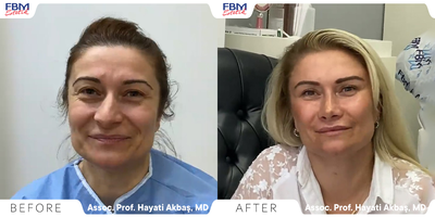 45-54 year old woman treated with Deep Plane Facelift - Deep Plane Facelift, Blephoryplasty, Necklift, Lipofilling.She is 43 years old single, she told the doctor: I'm really tired, I feel like I'm getting old and I have low self-confidence, I can't look at people's faces when I talk to them. The doctor asked her if she could get back her self-confidence, would she consider marrying after the procedure? She answered: Why not, well see what will happen. After the operation, She mentioned that many things have changed in her life and the most important thing is the way she looks at her life.