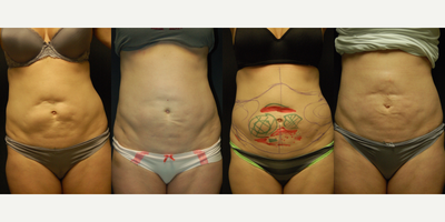 48 year old woman with post liposuction deformities treated with liposuction and fat grafting. - 48 year old woman had deformity of the abdominal wall after laser liposuction by a non-board certified doctor, with tethering of skin to the abdominal wall, depressions and irregularity of contour and residual excess fat. First procedure with Smartlipo done 18 months ago to even out the contours and free adhesions. Second procedure done 6 months ago with liposuction of the flanks and fat transfer to fill the abdominal contour defects. Further improvement would be possible with another fat grafting procedure.