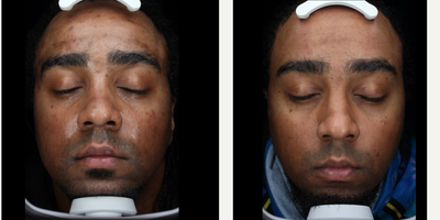 25-34 year old man treated with Clear and Brilliant - 2 months post 2 treatments