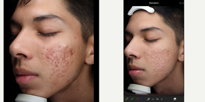 18-24 year old man treated with Intracel - After 3 treatments