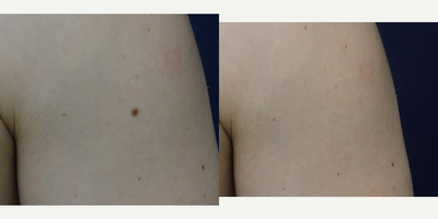 25-34 year old man treated with Mole Removal, Sclerotherapy - 26 year old male before and 11 weeks after 3 laser mole removal treatments to left shoulder/upper arm. There has been no recurrence as of 11 years after laser treatment.