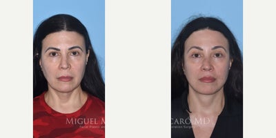 Woman treated with Brow Lift - Woman treated with Facelift, endoscopic Brow Lift, and Lip Lift