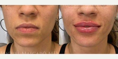 Woman treated with Lip Fillers - Woman treated with Lip Fillers