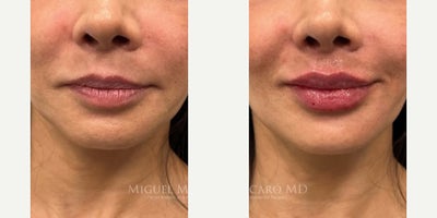 Woman treated with Lip Fillers - Woman treated with Lip Fillers using a full cc of Restylane Refyne