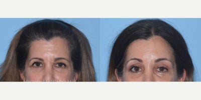 Woman treated with Brow Lift - Woman treated with endoscopic Brow Lift to open the eyes, and set the brows in the appropriate position.