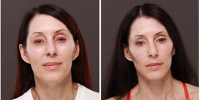 45-54 year old woman treated with Facelift Revision - Revison Facelift with fat grafting