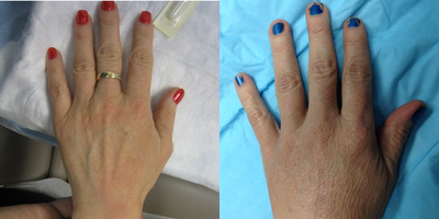 Case #Hand rejuvenation Patient - Plumping the hands via fillers can help avoid the veiny bony  look of older appearing hands. In this case we used Radiesse filler.