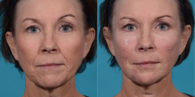55-64 year old woman treated with Bellafill - 1 Kit BellaFill (5 syringes) to temples, midface, nasolabial folds, and marionette linesSoftFil microcannula technique to minimize bruising and swelling