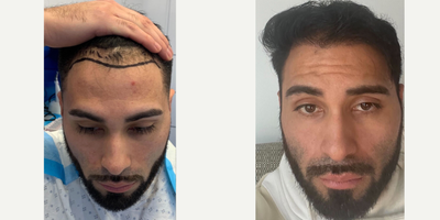 25-34 year old man treated with Hair Transplant - 29 year old patient received 1,500 FUE hair grafts to front hairline.