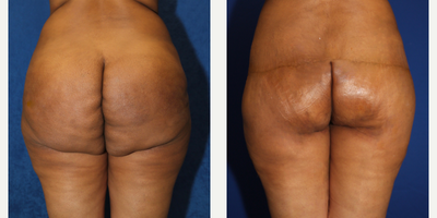 25-34 year old woman treated with Silicone Injection Removal - This is a 34 year old Black female patient who is 57 and weighs 160 pounds. She had raw silicone injected in her buttocks in 2011. She has been experiencing pain her buttocks and found Dr. J. Timothy Katzen for a consultation. Dr. Katzen removed the silicone from her buttocks (open technique) and she feels so much better now.