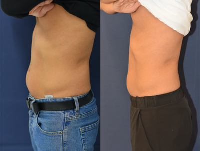 35-44 year old man treated with truSculpt iD - Our patient received our customized truSculptiD and truSculptflex combo treatment to address is the waistline, lower abdomen, and love handles. See these accelerated results in 4 weeks instead of 14! Metabolism increased as a result of the treatment for 14 weeks.