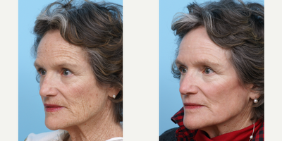 65-74 year old woman treated with CO2 Laser - This patient was bothered by her sunspots. She had one CO2 laser treatment done to have a more even skin complexion.