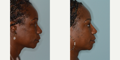 45-54 year old woman treated with African American Rhinoplasty, Rhinoplasty - 45-54 year old woman treated with African American Rhinoplasty, Rhinoplasty