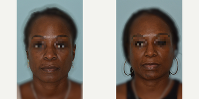 45-54 year old woman treated with African American Rhinoplasty, Rhinoplasty - 45-54 year old woman treated with African American Rhinoplasty, Rhinoplasty