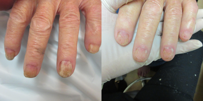 75 and up year old man treated with Laser Toenail Fungus Removal - Nail fungus removal on hands