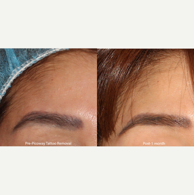 25-34 year old woman treated with PicoWay - The doctorused PicoWay to treat this patient's eyebrow tattoo.