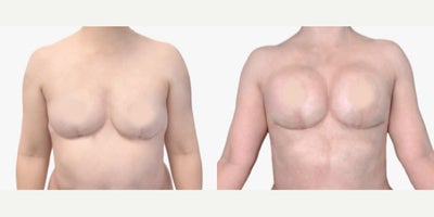 35-44 year old woman treated with Breast Fat Transfer - Lipoinjection is a suitable alternative to improving breast volume. It's a thorough method because it prevents rejection of the body's fat as it's the patient's fat, as well as other complications. By evaluating each case correctly, it is possible to obtain and meet patient expectations. The fat cells extracted to be seeded in the breast acquire a position in which the body can enervate them. This will make them stay and last with the right surgical technique.