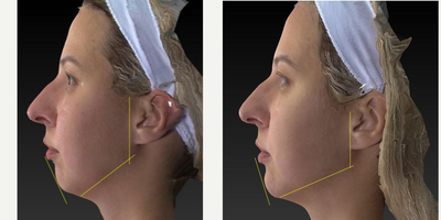 25-34 year old woman treated with Restylane Lyft - Restylane Lyft injection to help sculpt this young woman's jaw.