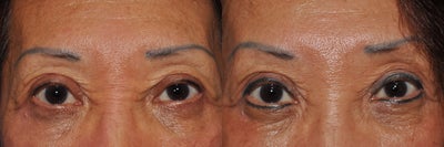 Permanent Eyeliner - 
	Permanent Eyeliner (Tattoo) - Upper and Lower Eyelids
