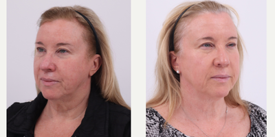 55-64 year old woman treated with BroadBand Light (BBL) - Before and after 2 sessions of BBL to treat rosacea and uneven skin tone