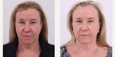 55-64 year old woman treated with BroadBand Light (BBL) - Before and after 2 sessions of BBL to treat rosacea and uneven skin tone