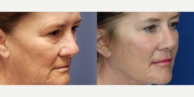 Woman treated with Eyelid Surgery - Woman treated with Eyelid Surgery