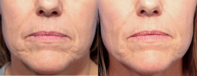55  year old woman treated with PRP Injections - PRP and filler combination for correction of peri-oral wrinkles.
