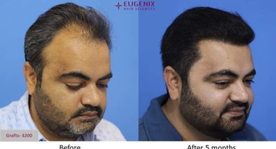 Hair Transplant Results | DHT| FUE @Eugenix Hair Sciences- 3287 grafts Fue