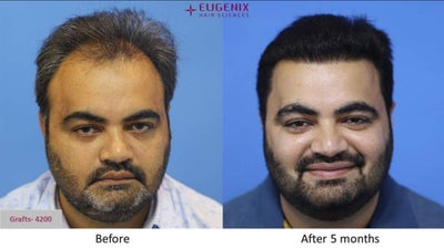 Hair Restoration I 4 Months update I 2202 Grafts  @EugenixHairSciencesofficial - YouTube