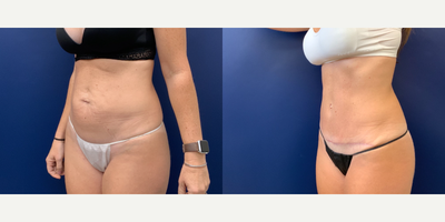 45-54 year old woman treated with Mini Tummy Tuck - Limited TT