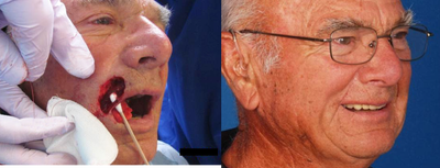 Mohs reconstruction of upper lip and commissure -
The patient underwent Mohs surgery to remove a skin cancer of the upper lip. Unfortunately a sizable defect creating a large through-and-through defect of the upper lip and commissure (see Q-tip placement) was necessary to remove all cancer. The patient underwent a single stage reconstruction with full oral motion and function maintained.