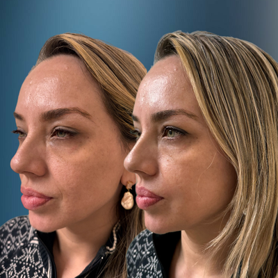 35-44 year old woman treated with Vampire Facelift, Botox, PRP Injections, Radiesse - Dr. Golberg's rejuvenating treatments. Using a special blend of Radiesse, plasma, and bio-stimulating agents, Dr. Golberg works magic to refresh your skin and bring back your natural glow. Say goodbye to wrinkles, sagging skin, and tiredness - and hello to radiance!