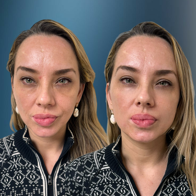35-44 year old woman treated with Vampire Facelift, Botox, PRP Injections, Radiesse - Dr. Golberg's rejuvenating treatments. Using a special blend of Radiesse, plasma, and bio-stimulating agents, Dr. Golberg works magic to refresh your skin and bring back your natural glow. Say goodbye to wrinkles, sagging skin, and tiredness - and hello to radiance!