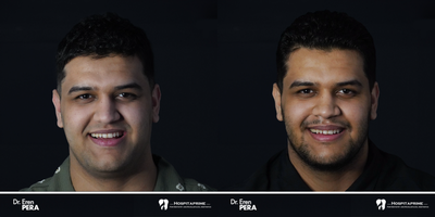 35-44 year old man treated with Jaw Surgery - Orthognathic surgery ( lefort 1 osteotomy, Sagittal split ramus osteotomy, )