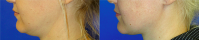 31 year old woman treated with Profound RF - 31 year old female who did not like the fullness and laxity to her face and neck. She had the PROFOUND RF treatment. 7&nbsp;weeks later you can see markedly more definition in her neck and jawline. Her results will continue to improve over the next 6 months.