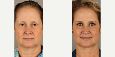 45-54 year old woman treated with Lip Fillers, Restylane Kysse, Cheek Augmentation, Restylane Lyft - 53-year-old female who requested youthful rejuvenation. She was noted to have relatively de-volumized lips and decreased cheek definition. She is shown 2 weeks after lip filler with Restylane Kysse and cheek augmentation with Restylane Lyft. Volume was added to her lateral cheeks to create a more heart-shaped face, and her lip volume was augmented while preserving shape and proportion.