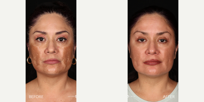 45-54 year old woman treated with Clear and Brilliant - Results of treatment for hyperpigmentation using Clear and Brilliant.