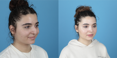 18-24 year old woman treated with Rhinoplasty - 18 years old female, 8 months after her Rhinoplasty, she is very happy with the results