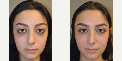 18 year old female, underwent orbital decompression to correct bulging eyes from Graves disease. - 18 year old female, with bulging eyes from Graves disease in teenage years, underwent orbital decompression surgery to restore her eyes to more normal, natural shape and function.