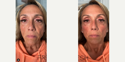Woman treated with Cheek Fillers - This client suffered from excessive volume loss of her cheeks. Her main concern was the hollowness of her mid face and undereyes, as well as the lines around her mouth.