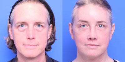 45-54 year old transgender woman treated with Facial Feminization Surgery - browlift, brow bone reduction, hairline advancement, rhinoplasty, lip lift with augmentation, FGI - face, mandible/chin contouring, facelift, bilateral lower blepharoplasty, submental liposuction, HALO-full face, sliding genioplasty