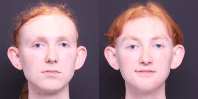 18-24 year old transgender woman treated with Facial Feminization Surgery - thyroplasty, brow lift, brow bone reduction, hairline advancement, lip lift, mandible/chin contouring, sliding genioplasty, submental liposuction