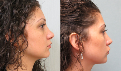 25-34 year old woman treated with Kybella - This patient had 1 treatment of Kybella to her neck