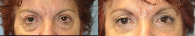67 Year Old Treated for Unacceptable Cosmetic Appearance of the Eyes - 
	67 Year Old Female Diagnosis: Unacceptable Cosmetic Appearance of Eyes Procedure: Upper &amp; Lower Blepharoplasty
