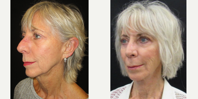 65-74 year old woman treated with Facelift, Facial Fat Transfer, Brow Lift, Eyelid Surgery - 71 y.o. female who received a facelift with fat grafting, upper and lower lid blepharoplasty and browlift.