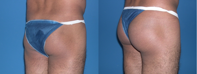 Male Butt Augmentation - 41 yo male who underwent buttock augmentation with solid silicone implants