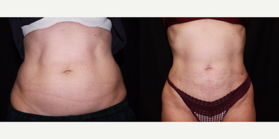 Laser Liposuction - Abdomen - Laser Liposuction - Abdomen