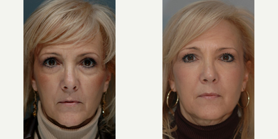 55-64 year old woman treated with Fat Transfer - Blepharoplasty, Lower, Periorbital and cheek fat injections, perioral and periorbital TCA peel.